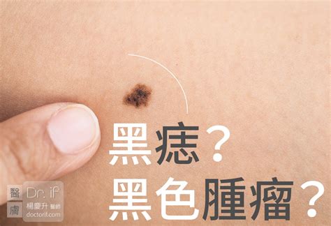 陰囊 黑痣|皮膚科王修含醫師: 男性外生殖器：皮膚病灶之診斷